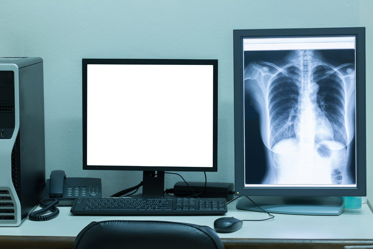 Chest X-ray